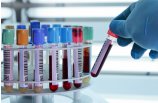 Plasma rico en plaquetas (PRP)