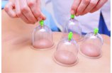 colocacin de ventosas
